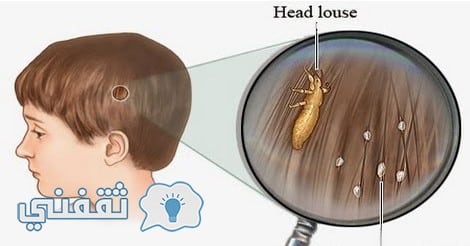 طريقة طبيعية فعالة وسريعة للقضاء على قمل الشعر نهائياً
