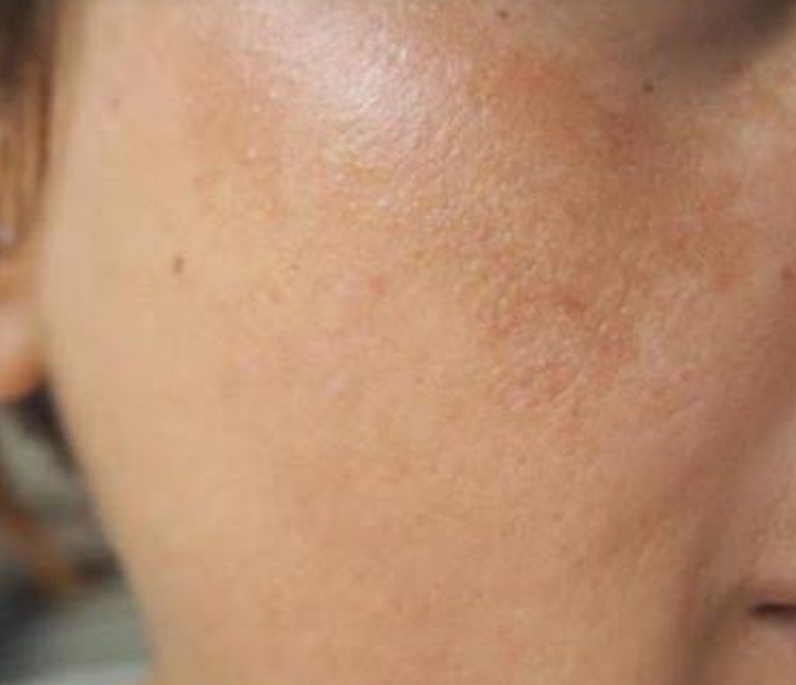 علاج الكلف في الوجه وعلاج البقع السوداء في الوجه وتفتيح الوجه في اسبوع فقط بمكونات طبيعية