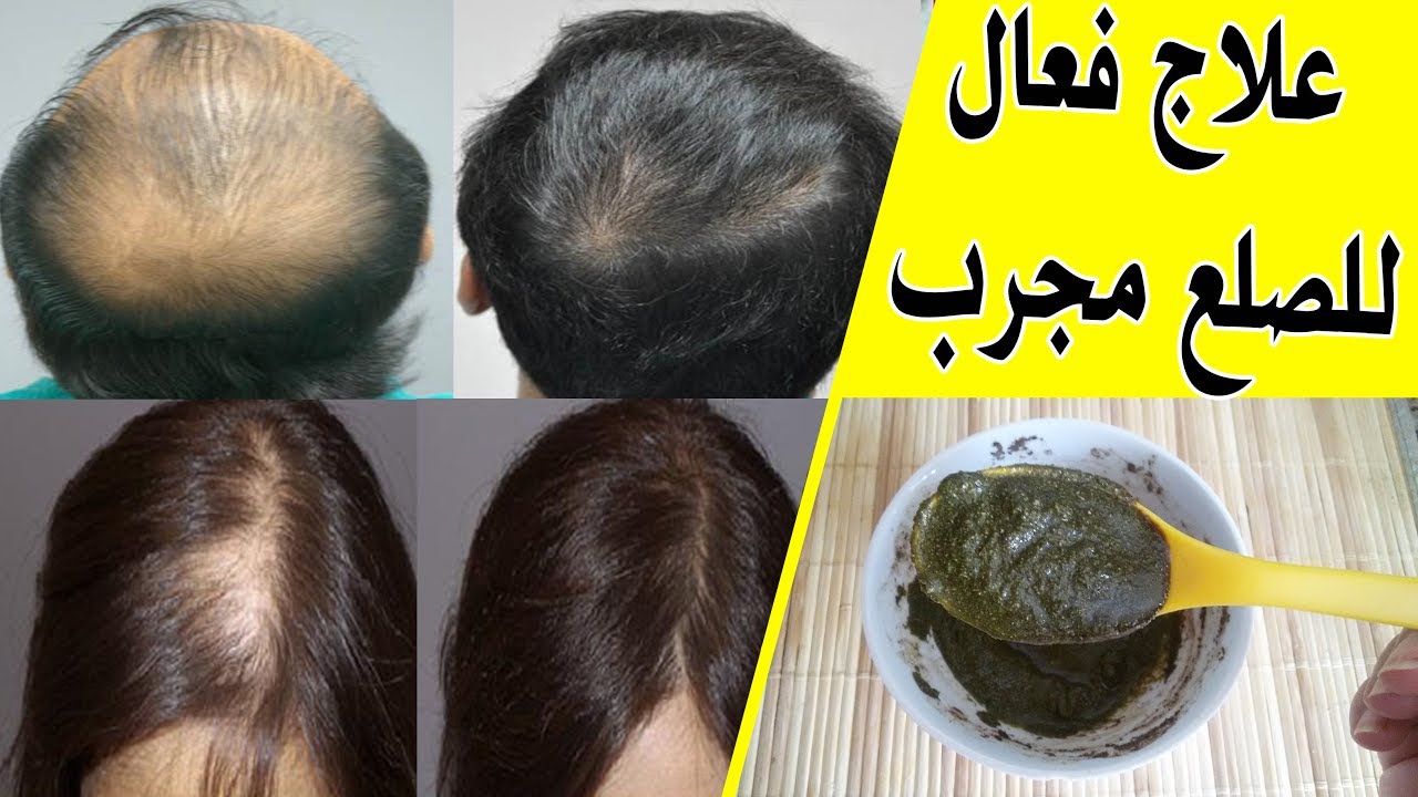 علاج تساقط الشعر نهائيا أقوي وصفة لعلاج الصلع وأنبات فراغات الشعر
