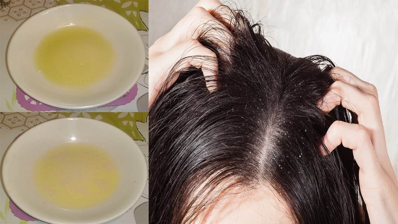 علاج قشرة الشعر بخلطة السكر والعسل والعديد من الخلطات الأخرى والنتيجة وهم