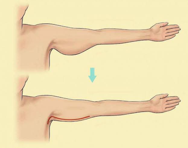 التخلص من ترهلات الذراعين