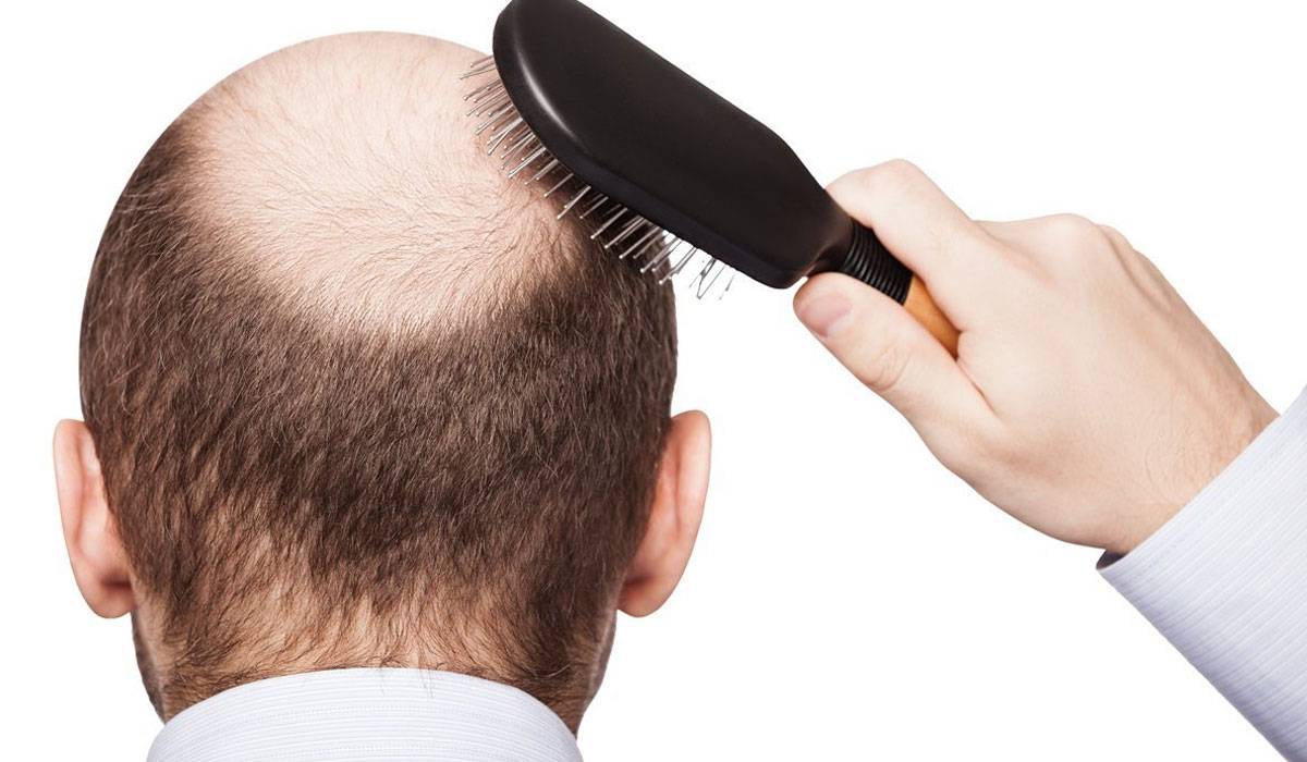 وصفات علاج سقوط الشعر