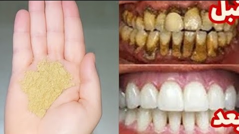 تبييض الأسنان وإزالة الجير في 5 دقائق تزيل الاصفرار وتسقط الجير مباشرة بعد فرك أسنانك بها