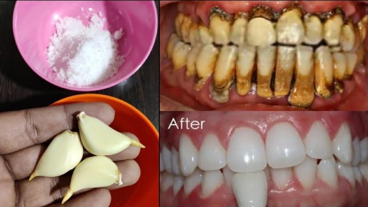“هتنور من البياض” طريقة تحضير وصفة تبييض الأسنان بطرق سهلة وسريعة بعدة خطوات