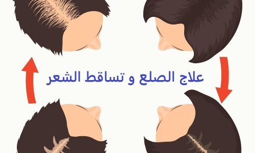 تعرف على طريقة تكثيف الشعر