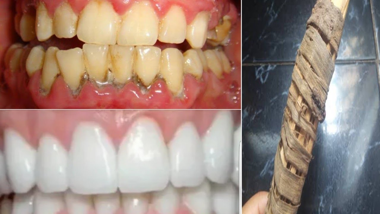 مكون كنز بنرمية لتبييض الاسنان هتصبح كالؤلؤ والتخلص من الجير والاصفرار والتسوس نهائيا