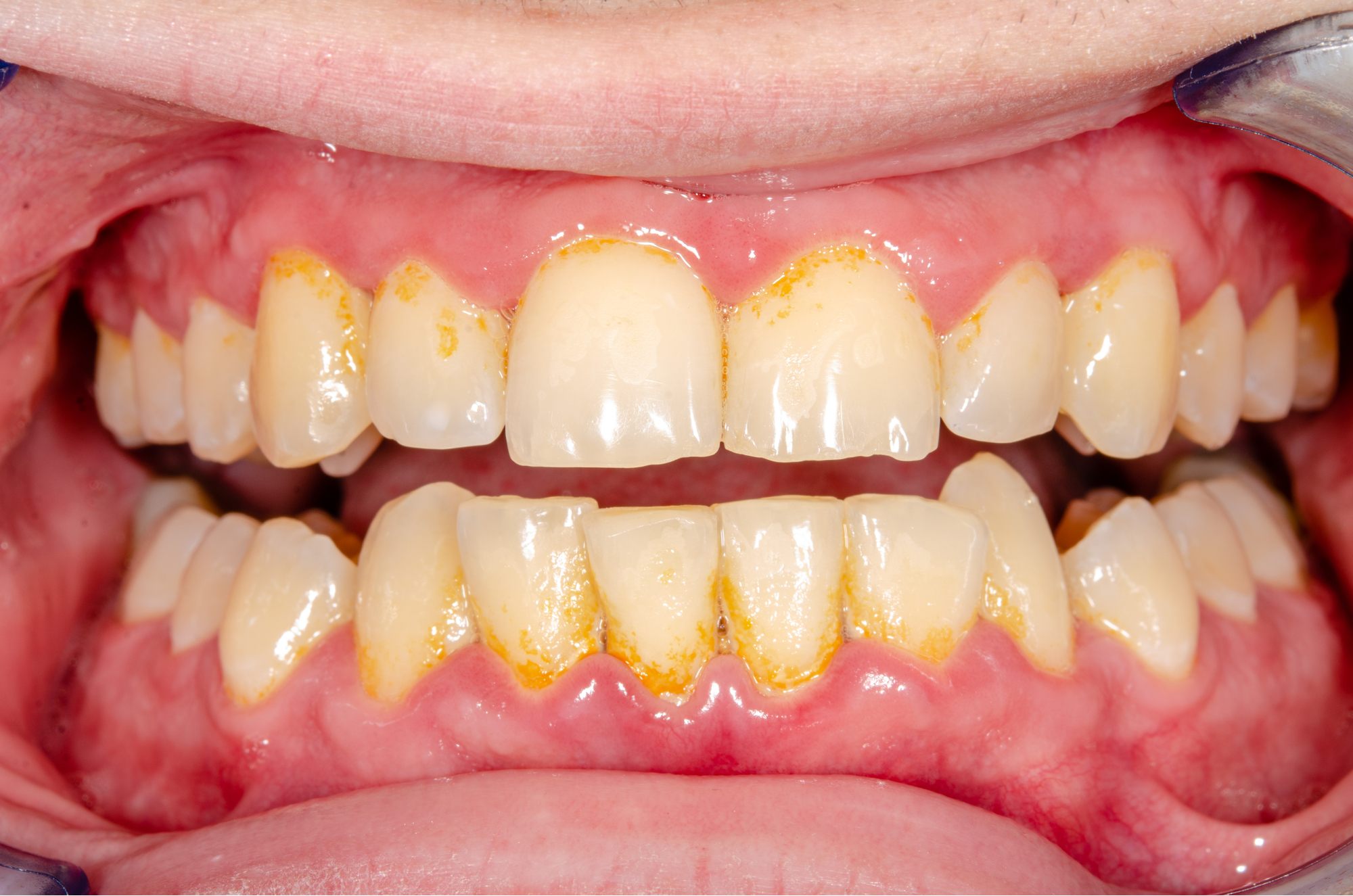 ازالة الجير الاسنان في المنزل بدون طبيب… طرق طبيعيه لازاله جير الاسنان