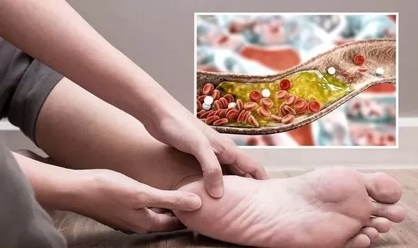 3 علامات خطيرة إذا ظهرت على أصابع قدميك تشير إلى ارتفاع نسبة الكوليسترول في الدم أذهب إلى الطبيب فوراً