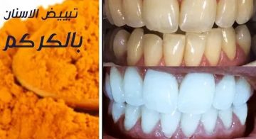 النشا والكركم لتبييض الأسنان: وإزالة الاصفرار في دقيقتين فوري ونتيجة مضمونة2022