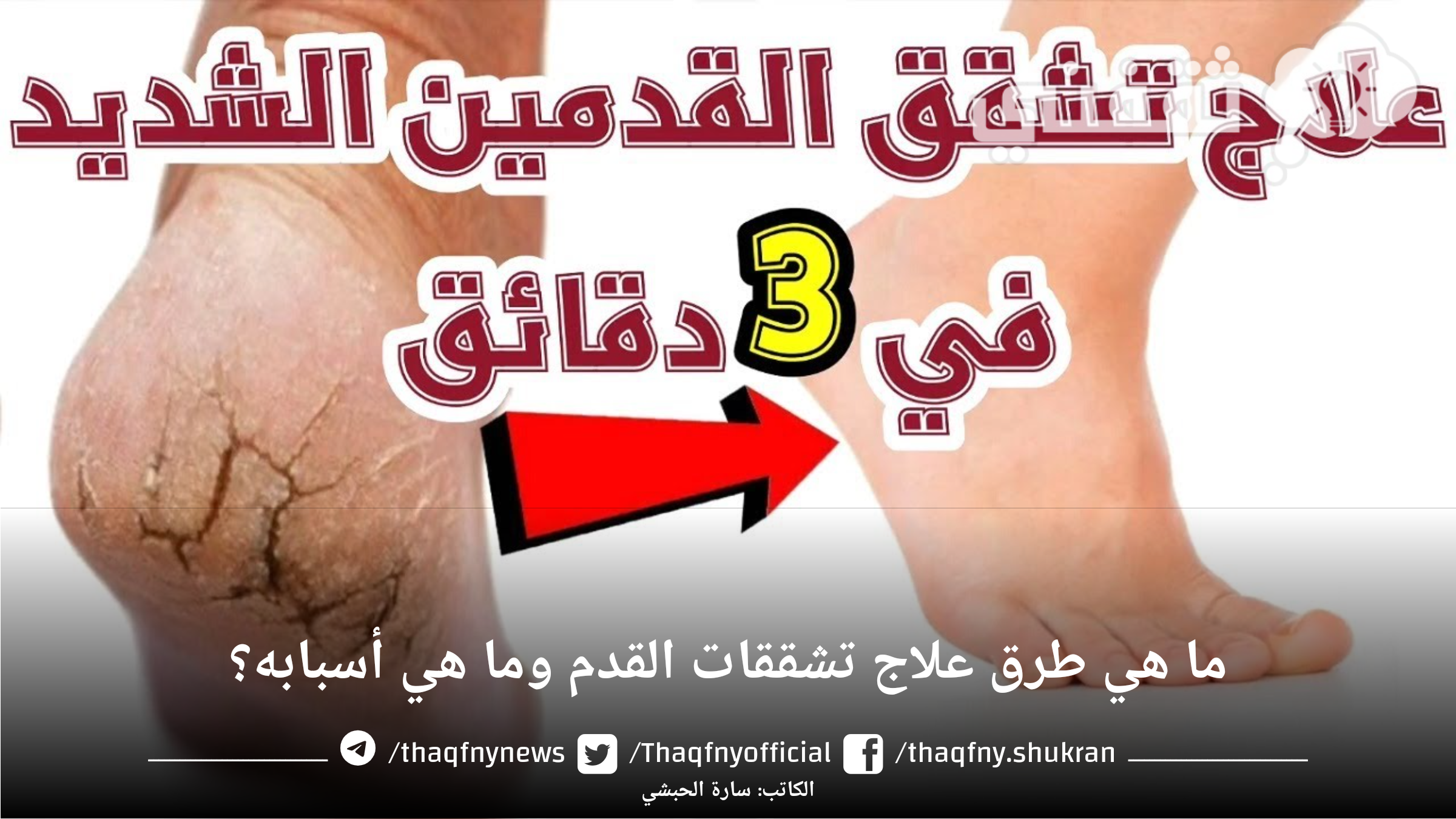 كيف تتخلص من تشقق القدمين؟ وما هي أسبابها وطريقة علاجها؟