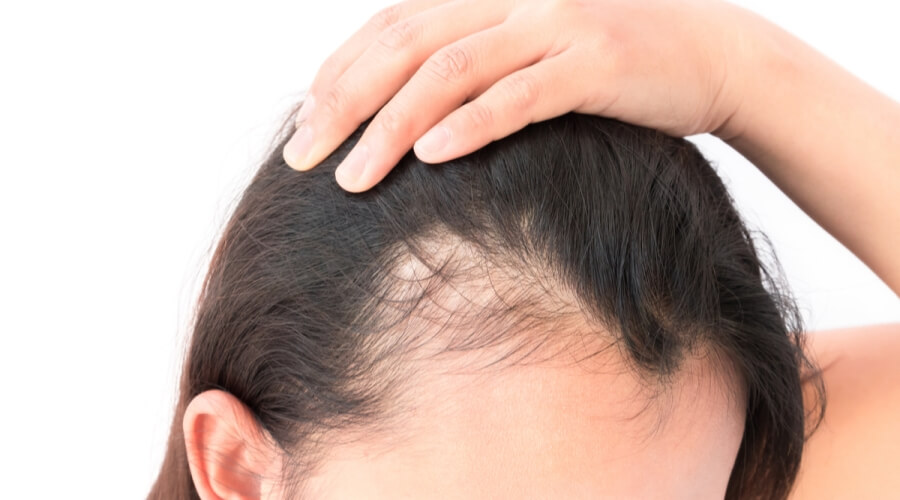 طرق علاج الشعر المنحول من الأمام في المنزل للرجال والنساء