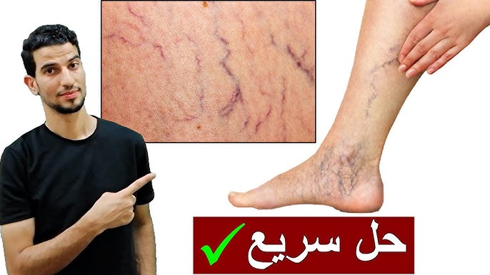 Natural Cream Recipe for Treating Varicose Veins at Home