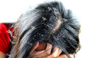 وصفة منزلية لإزالة القشرة من الشعر بشكل نهائي وعلاج الحكة من اول استخدام